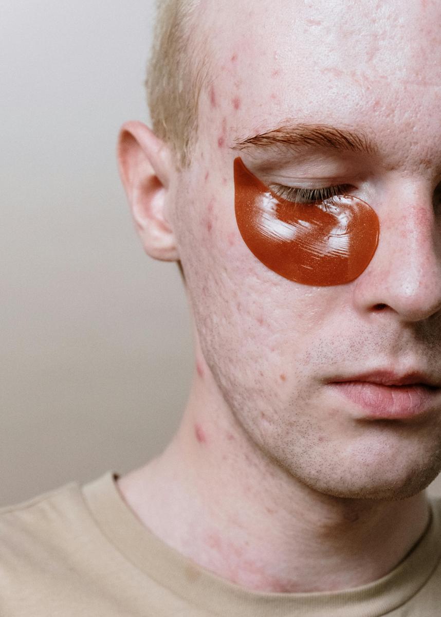 acne skincare