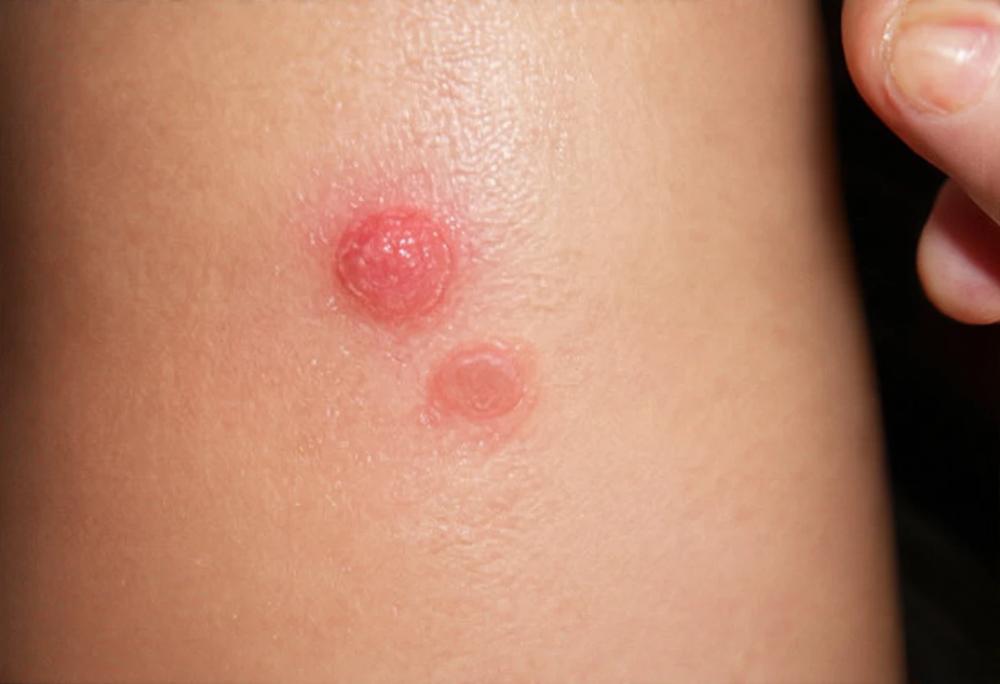 skin hives