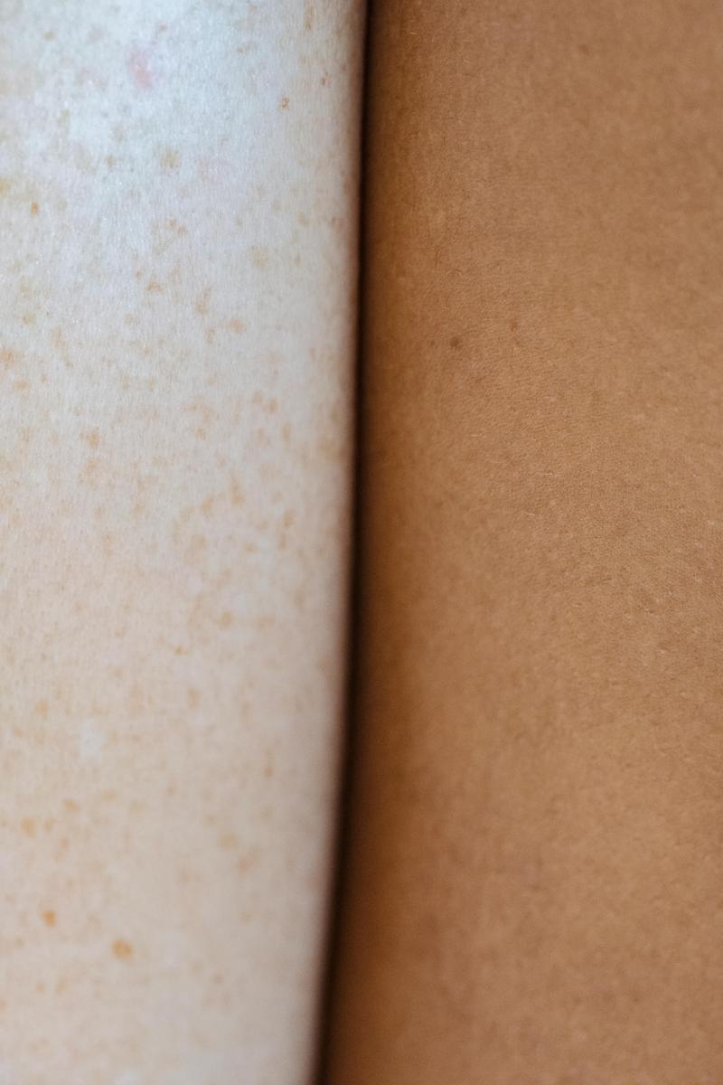 skin imperfections