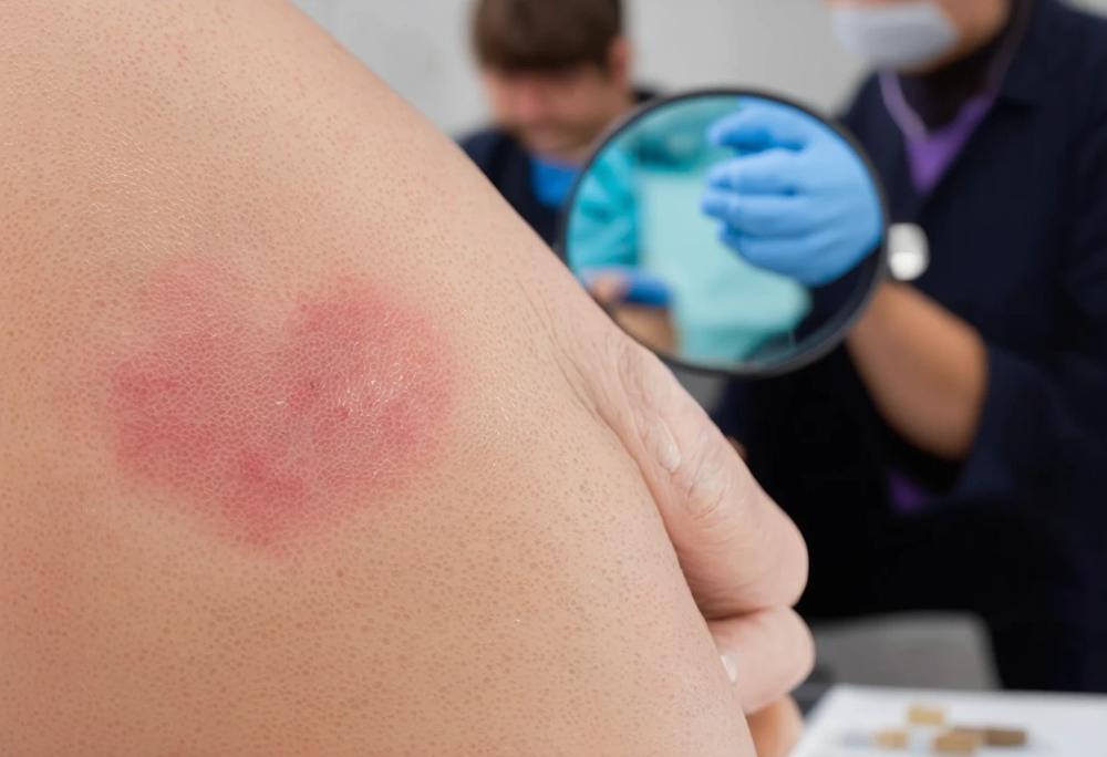 skin infestation